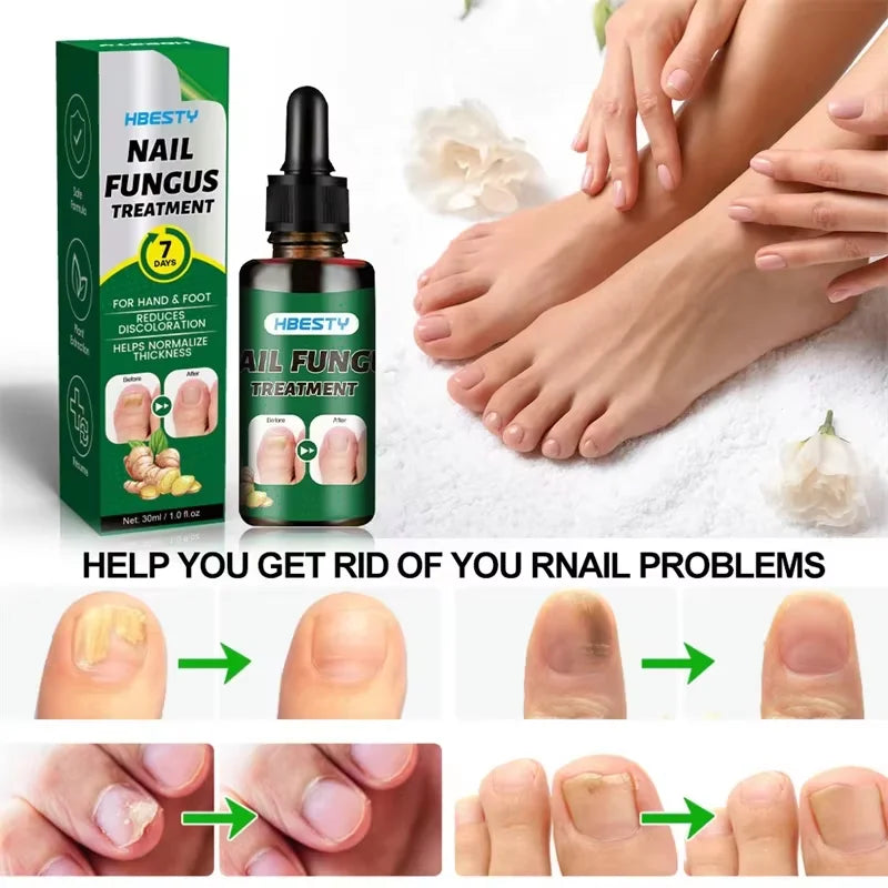 Nail Fungus Lab ON Gel